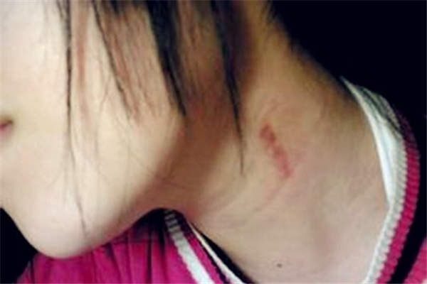 吻痕用雞蛋熱敷管用嗎 吻痕用雞蛋敷過后什么時(shí)候能消