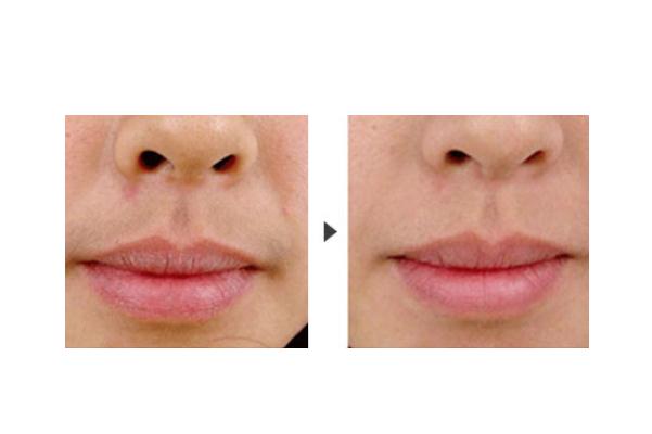 唇毛會(huì)自己慢慢消失嗎 唇毛會(huì)自己脫落嗎