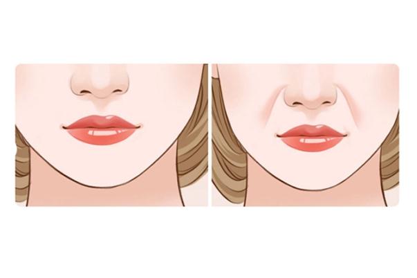 法令紋是怎么導(dǎo)致出來的 法令紋去除最好的方法 法令紋是怎么導(dǎo)致出來的 法令紋去除最好的方法