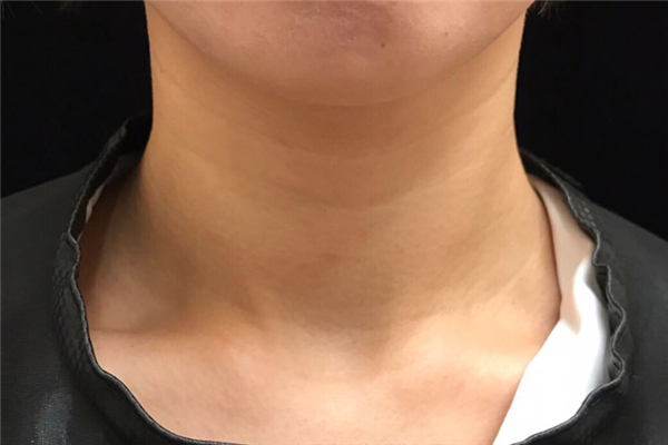 頸紋跟年齡有關(guān)系嗎 頸紋一般多大年齡會(huì)出現(xiàn)