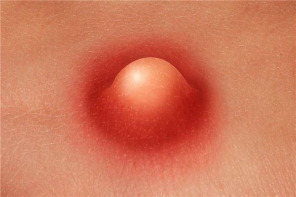 火癤子有了白點可以擠破嗎 火癤子可以刺破嗎