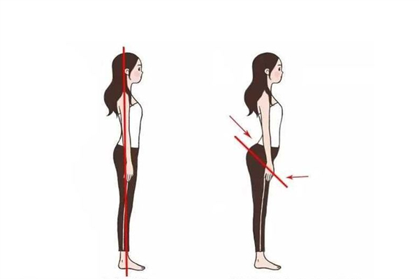 骨盆前傾有必要矯正嗎 骨盆前傾對身體的危害