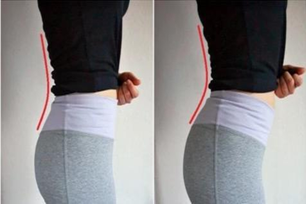 骨盆前傾小肚子會鼓起來嗎 骨盆前傾小腹突出怎么矯正