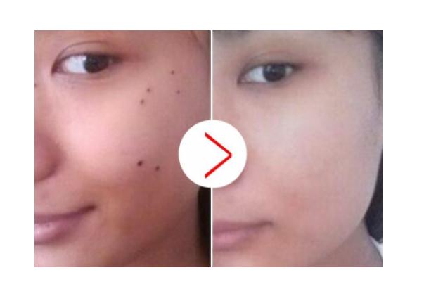 點痣留下的凹陷坑怎么修復 點痣多久可以恢復正常護膚 點痣留下的凹陷坑怎么修復 點痣多久可以恢復正常護膚