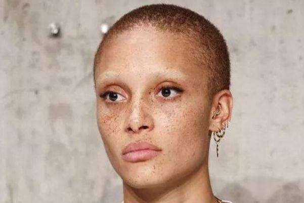 雀斑對(duì)身體有影響嗎 雀斑可以做光子嫩膚嗎 雀斑對(duì)身體有影響嗎 雀斑可以做光子嫩膚嗎