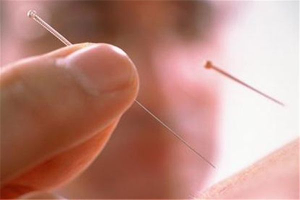 針灸會(huì)痛嗎 針灸有多疼