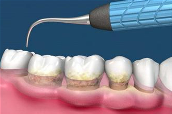 洗牙會造成牙齒松動嗎 洗牙會損害牙齒嗎 洗牙會造成牙齒松動嗎 洗牙會損害牙齒嗎
