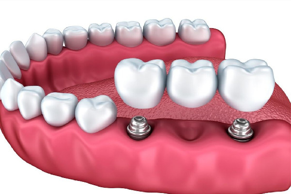 種牙前需要做些什么準備 種牙前驗血都驗什么 種牙前需要做些什么準備 種牙前驗血都驗什么