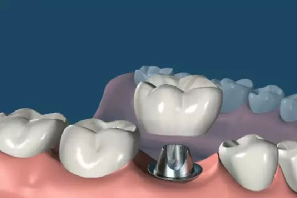 種牙后多長時間能吃飯 種牙后飲食應該注意什么