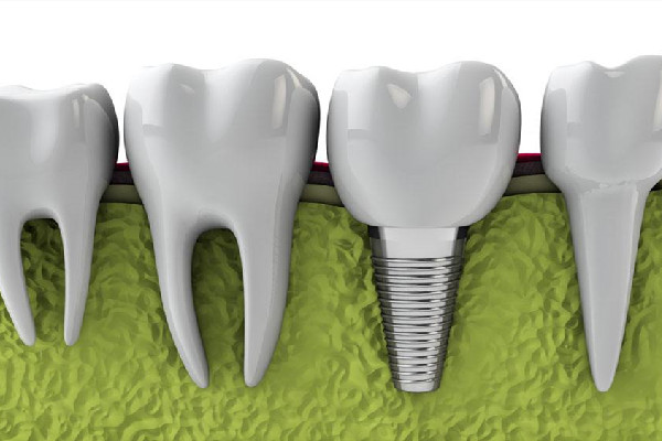 種牙后多長時間能吃飯 種牙后飲食應該注意什么