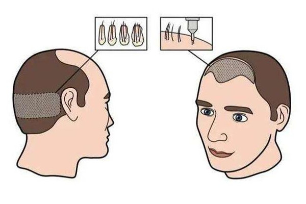 植發(fā)前需要做哪些準備 植發(fā)前驗血是要檢查什么