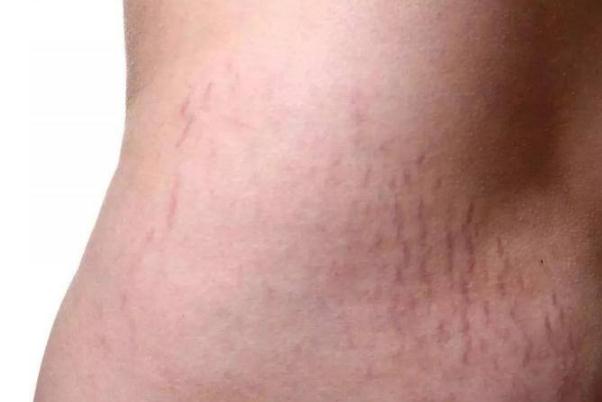 肥胖紋要注意什么 肥胖紋有什么影響嗎 肥胖紋要注意什么 肥胖紋有什么影響嗎