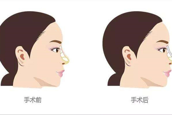 隆鼻后后遺癥有哪些呢 隆鼻手術(shù)后注意事項