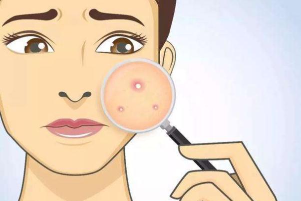 痘痘肌膚會不會遺傳 痘痘肌膚會自動修復(fù)嗎