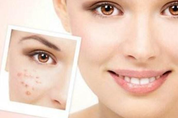 痘痘肌膚要涂防曬嗎 痘痘肌是先補(bǔ)水還是先祛痘