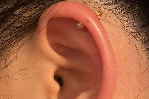 打耳骨怎么預(yù)防增生 打耳骨增生了怎么辦 打耳骨怎么預(yù)防增生 打耳骨增生了怎么辦