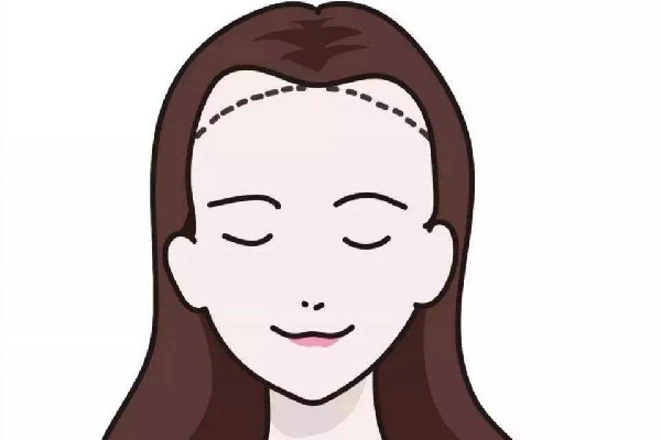 發(fā)際線(xiàn)會(huì)遺傳嗎 發(fā)際線(xiàn)會(huì)不會(huì)越來(lái)越高