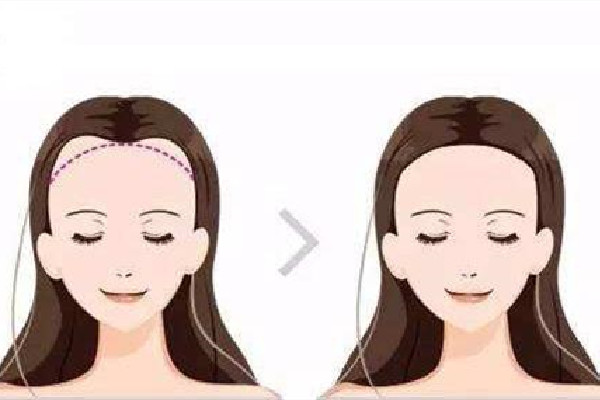 發(fā)際線(xiàn)幾種形狀 發(fā)際線(xiàn)什么樣的比較好 發(fā)際線(xiàn)幾種形狀 發(fā)際線(xiàn)什么樣的比較好