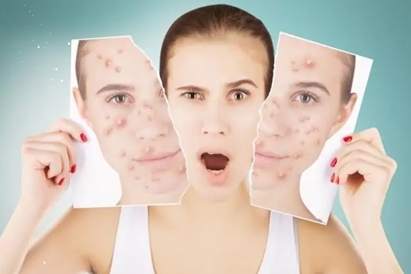 痘痘能用手?jǐn)D嗎 痘痘擠了會不會留疤