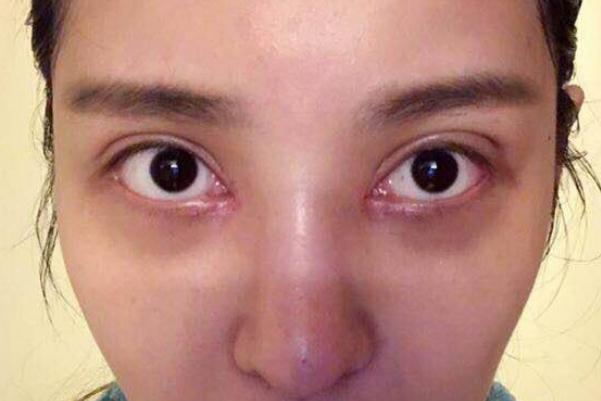 割雙眼皮可以吃炸雞嗎 割雙眼皮后護(hù)理 割雙眼皮可以吃炸雞嗎 割雙眼皮后護(hù)理