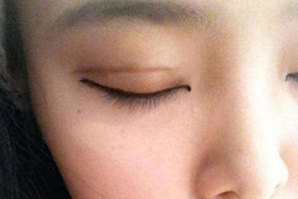 割雙眼皮有幾種方法 割雙眼皮有什么壞處 割雙眼皮有幾種方法 割雙眼皮有什么壞處