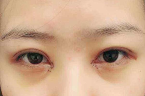 割雙眼皮可以吃炸雞嗎 割雙眼皮后護(hù)理 割雙眼皮可以吃炸雞嗎 割雙眼皮后護(hù)理