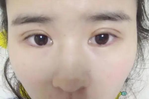 割雙眼皮可以吃炸雞嗎 割雙眼皮后護(hù)理 割雙眼皮可以吃炸雞嗎 割雙眼皮后護(hù)理