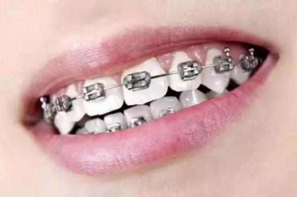 牙套的種類(lèi)和價(jià)格 牙套價(jià)格一般是多少錢(qián)一個(gè)