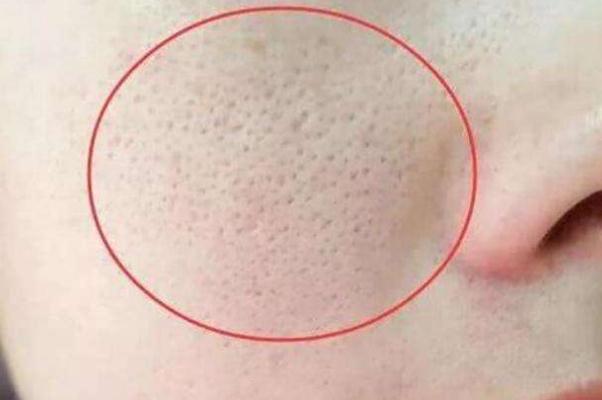 收縮毛孔最佳方法 收縮毛孔用什么比較好 收縮毛孔最佳方法 收縮毛孔用什么比較好