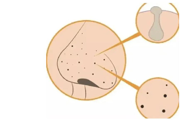 去黑頭產(chǎn)品排行榜10強(qiáng) 去黑頭收縮毛孔最好的方法