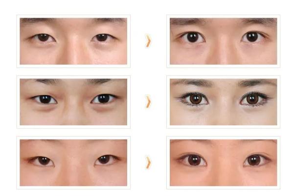 開眼角的恢復(fù)期是多久 開眼角要多久才能恢復(fù)正常 開眼角的恢復(fù)期是多久 開眼角要多久才能恢復(fù)正常