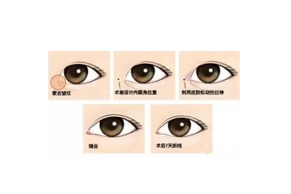 開眼角可以改善倒睫嗎 開眼角手術(shù)的安全性 開眼角可以改善倒睫嗎 開眼角手術(shù)的安全性