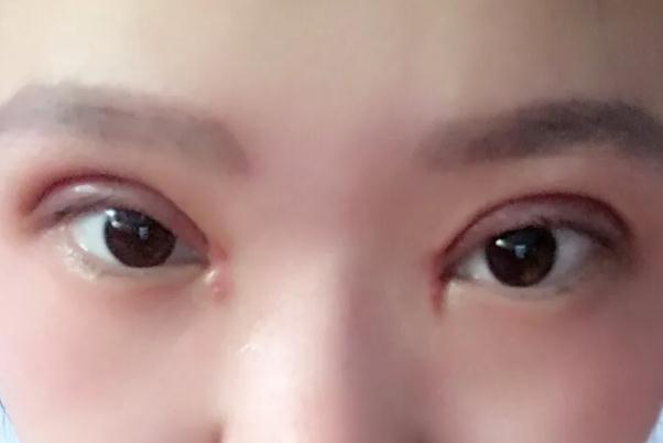 開眼角的恢復(fù)期是多久 開眼角要多久才能恢復(fù)正常 開眼角的恢復(fù)期是多久 開眼角要多久才能恢復(fù)正常