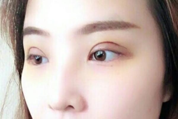 開(kāi)眼角是啥意思 開(kāi)眼角是大手術(shù)嗎