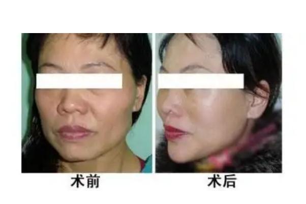 肉毒素除皺的注意事項 肉毒素除皺是永久的嗎 肉毒素除皺的注意事項 肉毒素除皺是永久的嗎