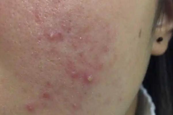 毛孔粗大會自己好嗎 毛孔粗大會導(dǎo)致什么后果