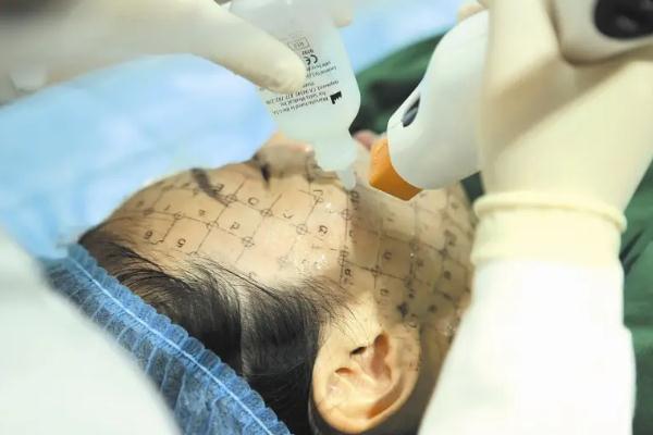 熱瑪吉會讓玻尿酸消失嗎 熱瑪吉會傷到面部神經嗎 熱瑪吉會讓玻尿酸消失嗎 熱瑪吉會傷到面部神經嗎