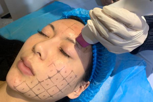 熱瑪吉要敷麻藥嗎 熱瑪吉要做幾次才有效果 熱瑪吉要敷麻藥嗎 熱瑪吉要做幾次才有效果