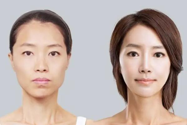 玻尿酸填充太陽(yáng)凹大概能維持多久 玻尿酸填充法令紋能保持多長(zhǎng)時(shí)間 玻尿酸填充太陽(yáng)凹大概能維持多久 玻尿酸填充法令紋能保持多長(zhǎng)時(shí)間