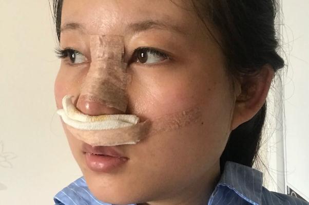 耳軟骨隆鼻會(huì)增生嗎 耳軟骨隆鼻會(huì)變低嗎