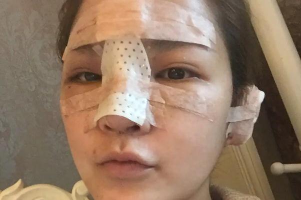 耳軟骨隆鼻有什么后遺癥 耳軟骨隆鼻有點(diǎn)歪可以調(diào)整嗎 耳軟骨隆鼻有什么后遺癥 耳軟骨隆鼻有點(diǎn)歪可以調(diào)整嗎