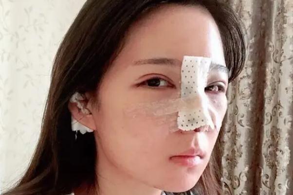 耳軟骨隆鼻耳軟骨還會(huì)長(zhǎng)起來(lái)嗎 耳軟骨隆鼻會(huì)頂破鼻尖嗎 耳軟骨隆鼻耳軟骨還會(huì)長(zhǎng)起來(lái)嗎 耳軟骨隆鼻會(huì)頂破鼻尖嗎