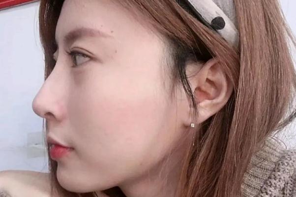 耳軟骨隆鼻耳軟骨還會(huì)長(zhǎng)起來(lái)嗎 耳軟骨隆鼻會(huì)頂破鼻尖嗎 耳軟骨隆鼻耳軟骨還會(huì)長(zhǎng)起來(lái)嗎 耳軟骨隆鼻會(huì)頂破鼻尖嗎