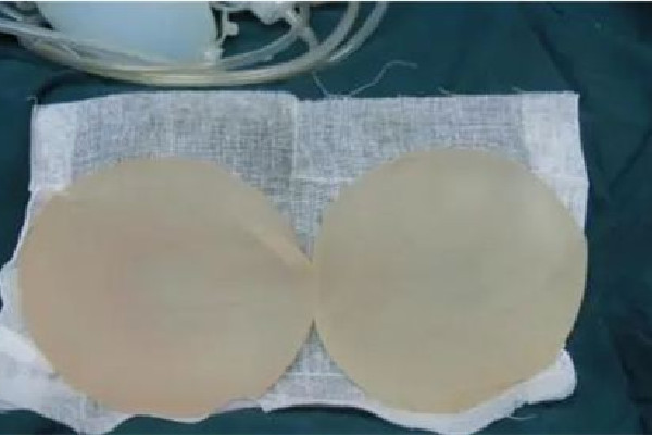 假體隆胸可以一輩子不取出來(lái)嗎 假體隆胸是怎么放進(jìn)去的