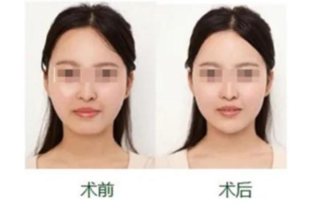 豐下巴會不會產(chǎn)生木偶紋 豐下巴會不會臉部下垂 豐下巴會不會產(chǎn)生木偶紋 豐下巴會不會臉部下垂