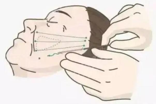 拉皮手術(shù)有后遺癥嗎 拉皮手術(shù)有風(fēng)險嗎 拉皮手術(shù)有后遺癥嗎 拉皮手術(shù)有風(fēng)險嗎