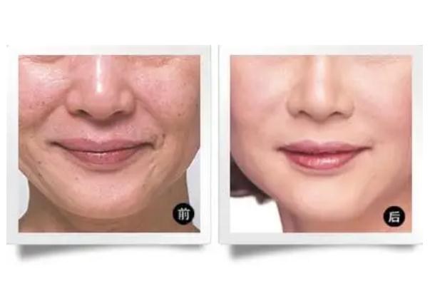 拉皮手術有生命危險嗎 拉皮手術會留疤痕嗎