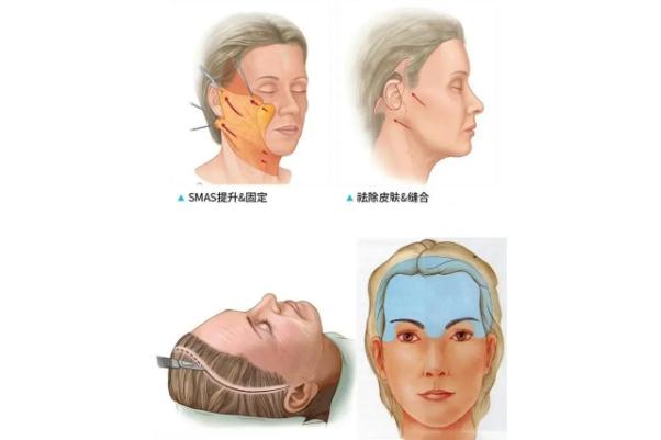 拉皮手術(shù)能維持幾年 拉皮手術(shù)多久恢復(fù)自然 拉皮手術(shù)能維持幾年 拉皮手術(shù)多久恢復(fù)自然