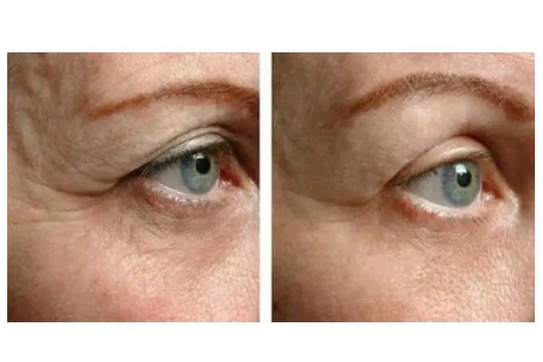 拉皮手術有生命危險嗎 拉皮手術會留疤痕嗎