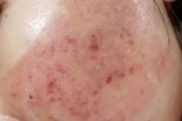 激光祛痘可以根治嗎 經期可以做激光祛痘嗎